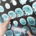 Экспериментальное лечение болезни Альцгеймера замедляет снижение когнитивных функций