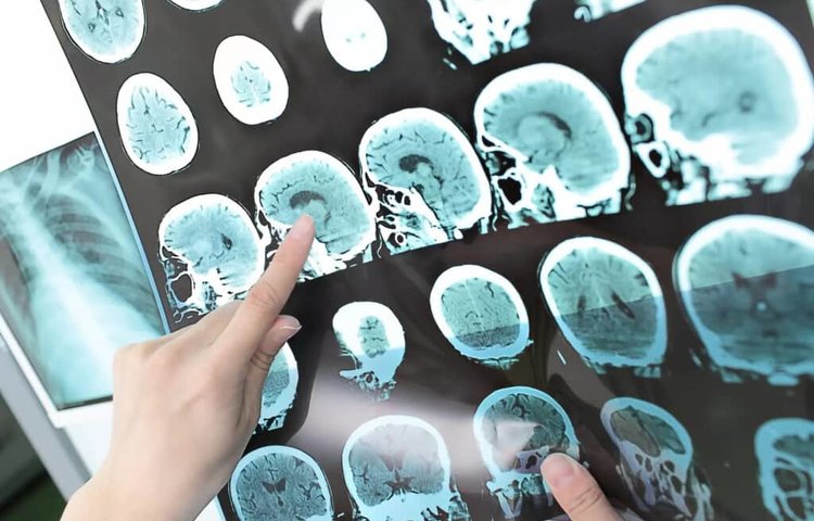 Экспериментальное лечение болезни Альцгеймера замедляет снижение когнитивных функций