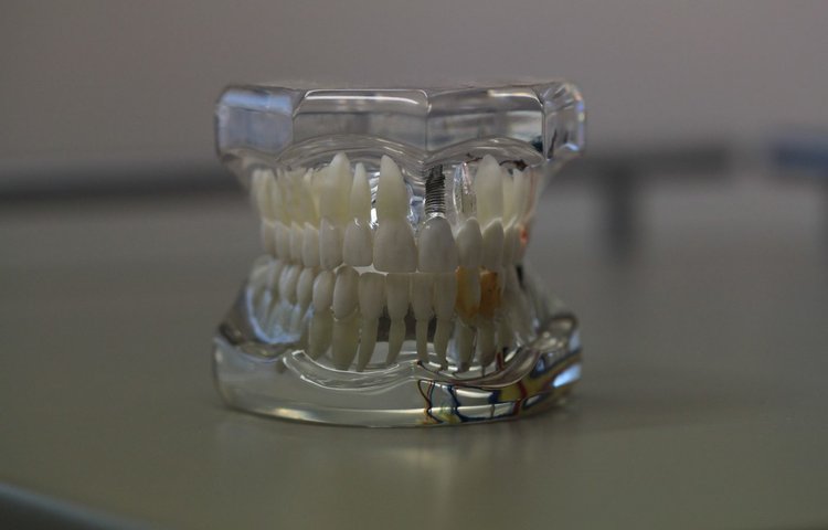 Зубное биопокрытие, похожее на натуральную эмаль, но более стойкое
