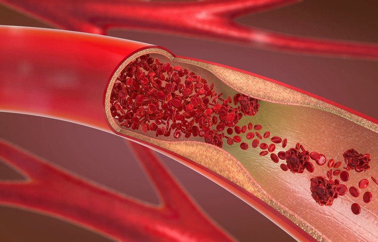 Заражение COVID-19 повышает риск легочной тромбоэмболии в течение 30 дней в 33 раза