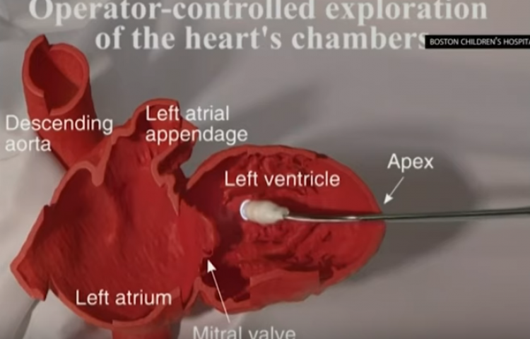Роботизированная трубка пробивается сквозь бьющееся сердце без помощи врача (Видео)